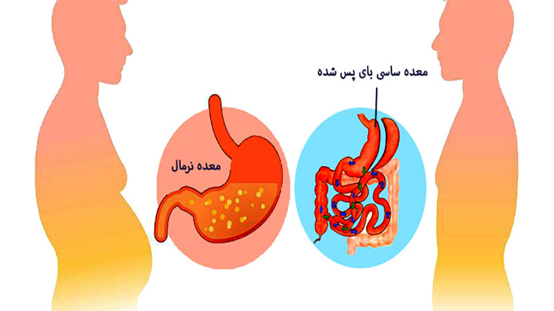 فواید عمل ساسی بای پس معده