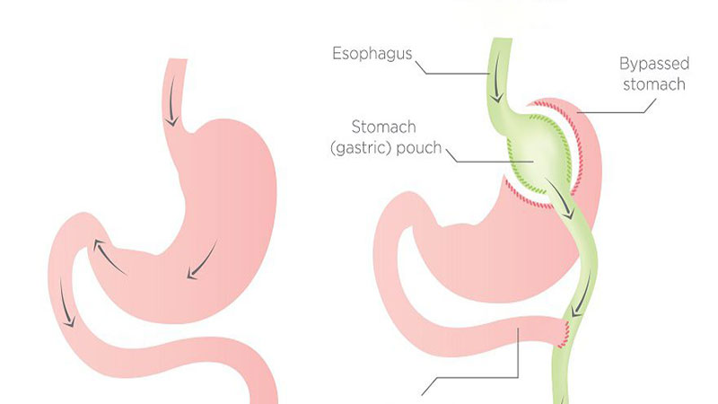 جراحی بای پس معده