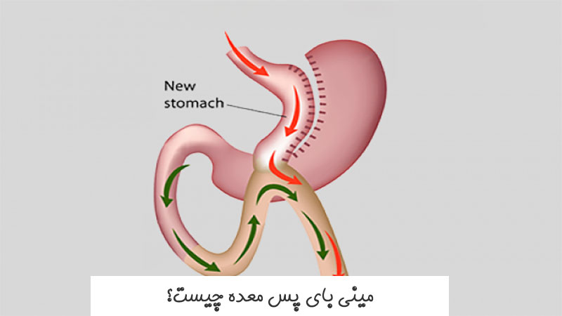 مینی بای پس معده