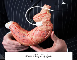عمل باندینگ معده