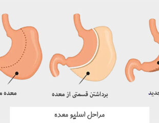 مراحل اسلیو معده