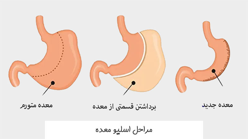 مراحل اسلیو معده