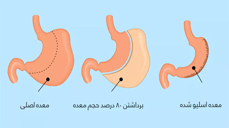 عمل اسلیو معده چیست