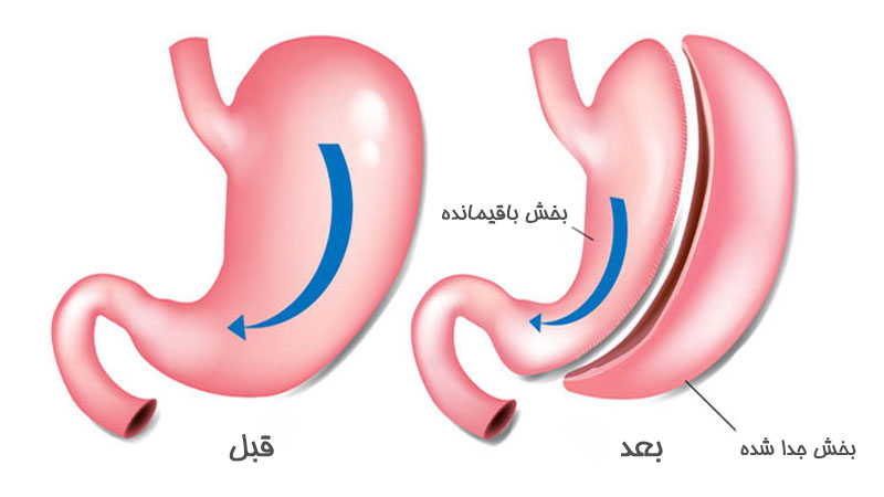 عمل لاغری امگا