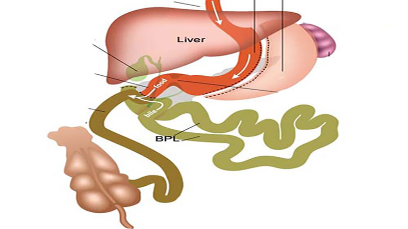 بای پس روده
