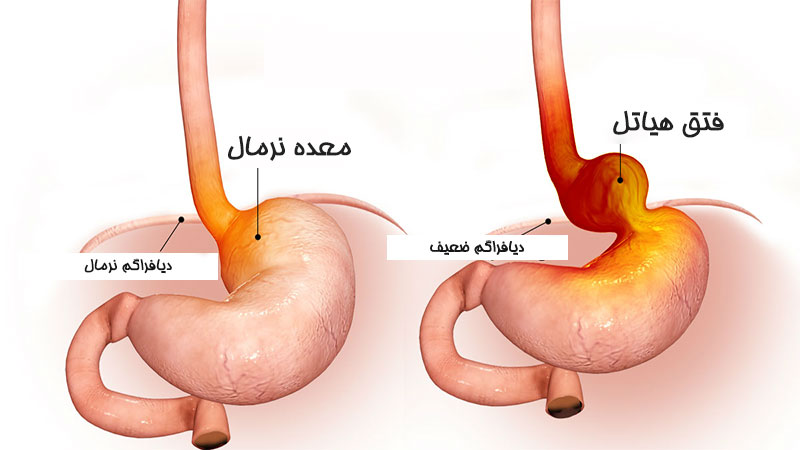 فتق هیاتل