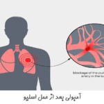 آمبولی بعد از عمل اسلیو