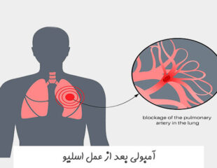 آمبولی بعد از عمل اسلیو