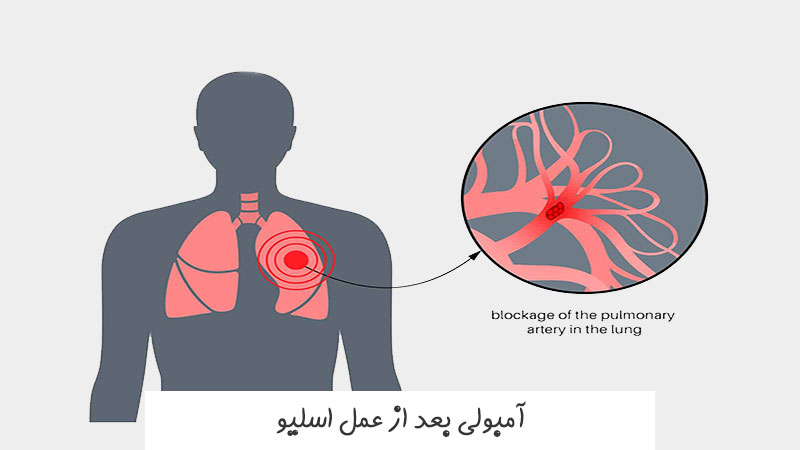 آمبولی بعد از عمل اسلیو