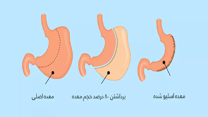 عمل اسلیو معده