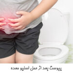 یبوست بعد از عمل اسلیو معده