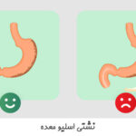 نشتی اسلیو معده