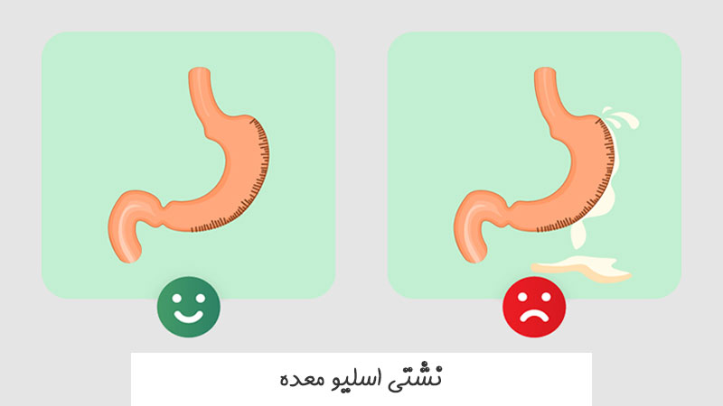 نشتی اسلیو معده