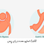 تفاوت اسلیو معده و بای پس