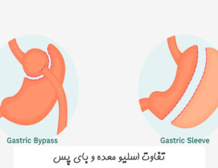 تفاوت اسلیو معده و بای پس